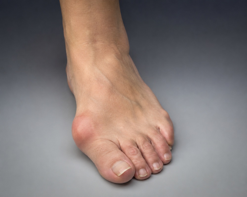 Hallux valgus